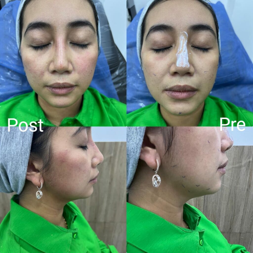 تجميل الوجه والخدود